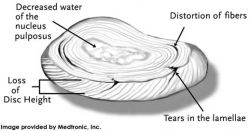 Medtronic_disc_annulartear_250_131_80