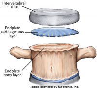 Medtronic_disctobone_200_182_80