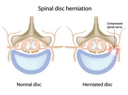spine_compareherniation_450_335_80