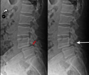 parsfracture_300_253_80